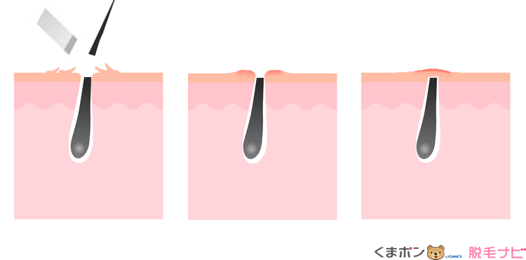 カミソリによるムダ毛処理