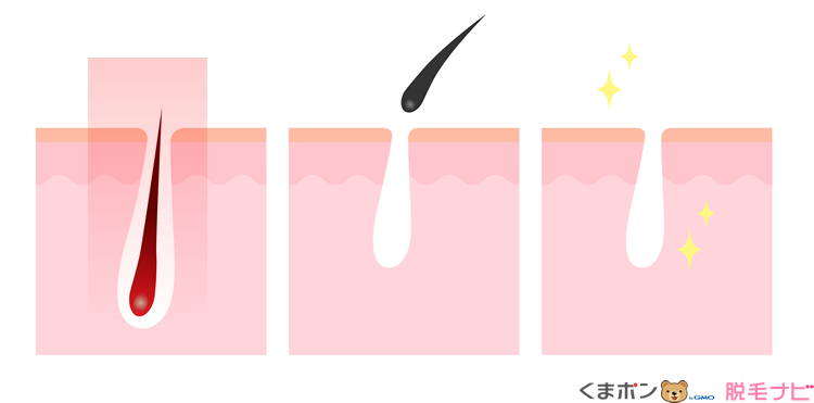 サロン脱毛の仕組み