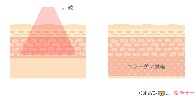 全身脱毛で得られる嬉しい美肌効果