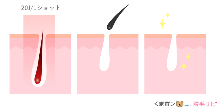 光脱毛器の出力パワー