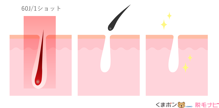 レーザー脱毛器の出力パワー