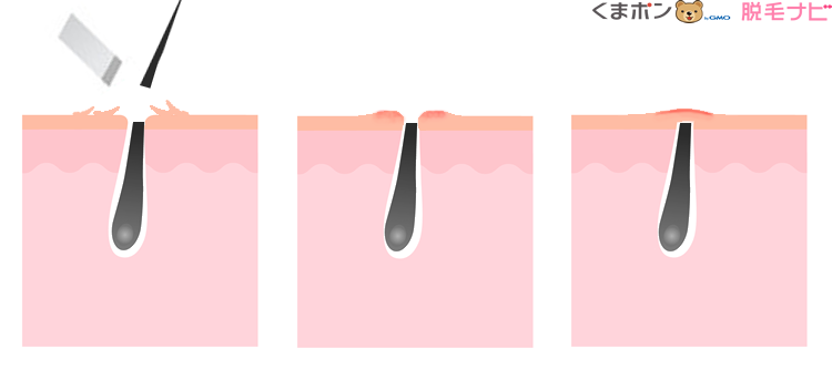 カミソリで剃る