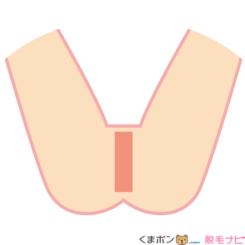 Iライン(陰部の両側)